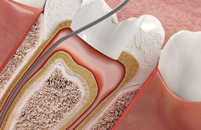 Zahn Endodontie Wurzelkanalbehandlung